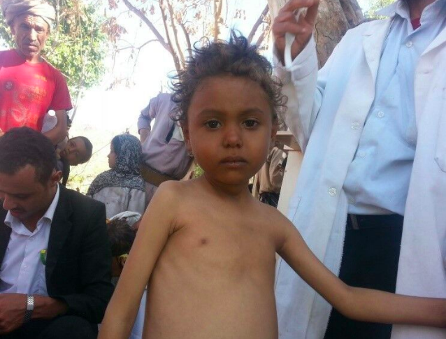 A malnourished child from Dhamar who has been screened and is receving treatment through integrated mobile team services, 2017