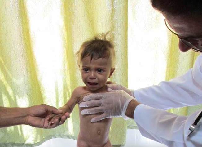 Severe acutely malnourished child on admission at PHC in Aleppo governorate