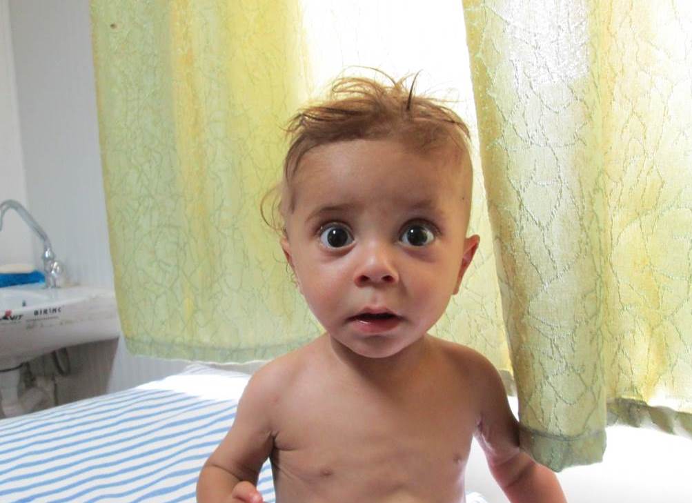Severe acutely malnourished child a?er 3 weeks treatment