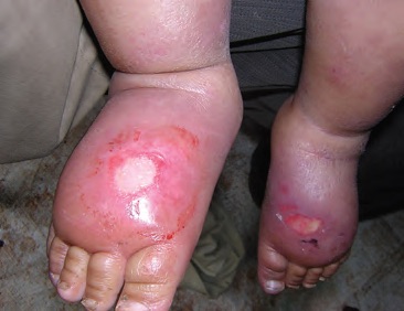 Bilateral oedema with pressure ulcer on a young child