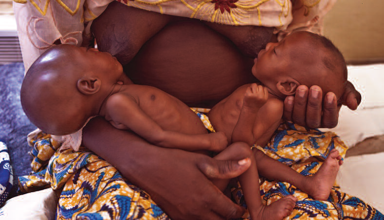 Malnourished 3 month old twins in Niger: the field reality behind the launch of the en-net thematic area for this age group
