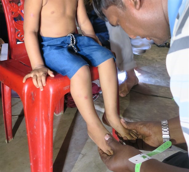 Verification of oedema from a nutrition survey in Bangladesh, 2018