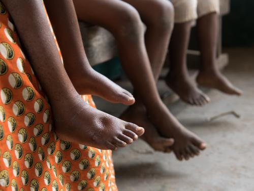 A photo of a child's feet shows signs of oedema, a build-up of excess fluid, which indicates malnutrition