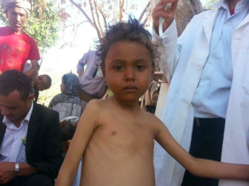 FB a malnourished child from Dhamar who has been screened and is recieving treatment through integrated mobile 